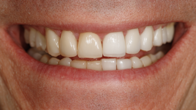 Unlocking the Benefits of Multi Abutments: Revolutionizing Dental Implants for Optimal Results