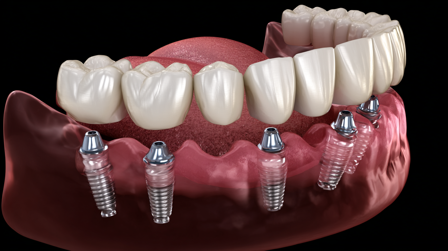 Exploring the Benefits of Angulated Implants for Complex Dental Cases