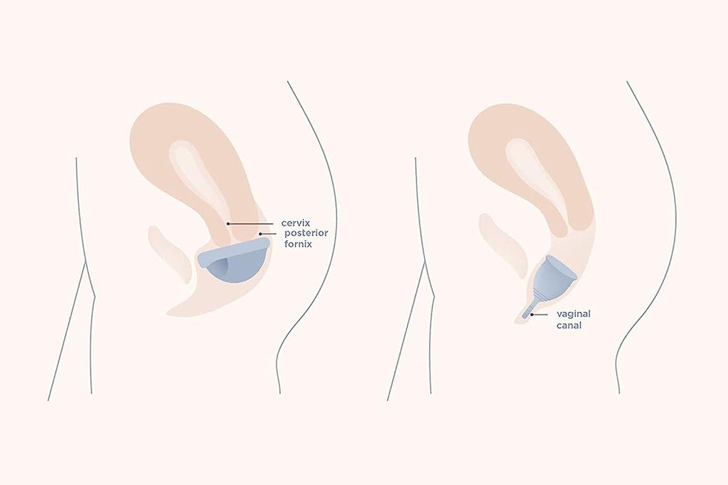 Wholesale & Manufacturing Guide: High-Capacity Menstrual Discs for Heavy Flow  