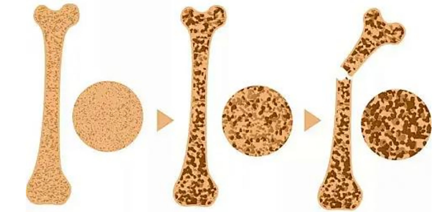 Bone Health2