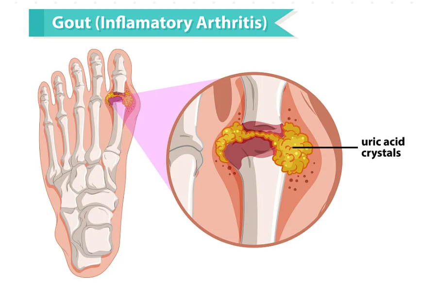 About Gout