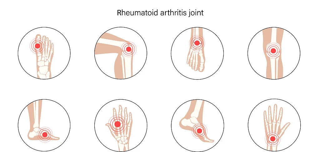 About Gout (4).png