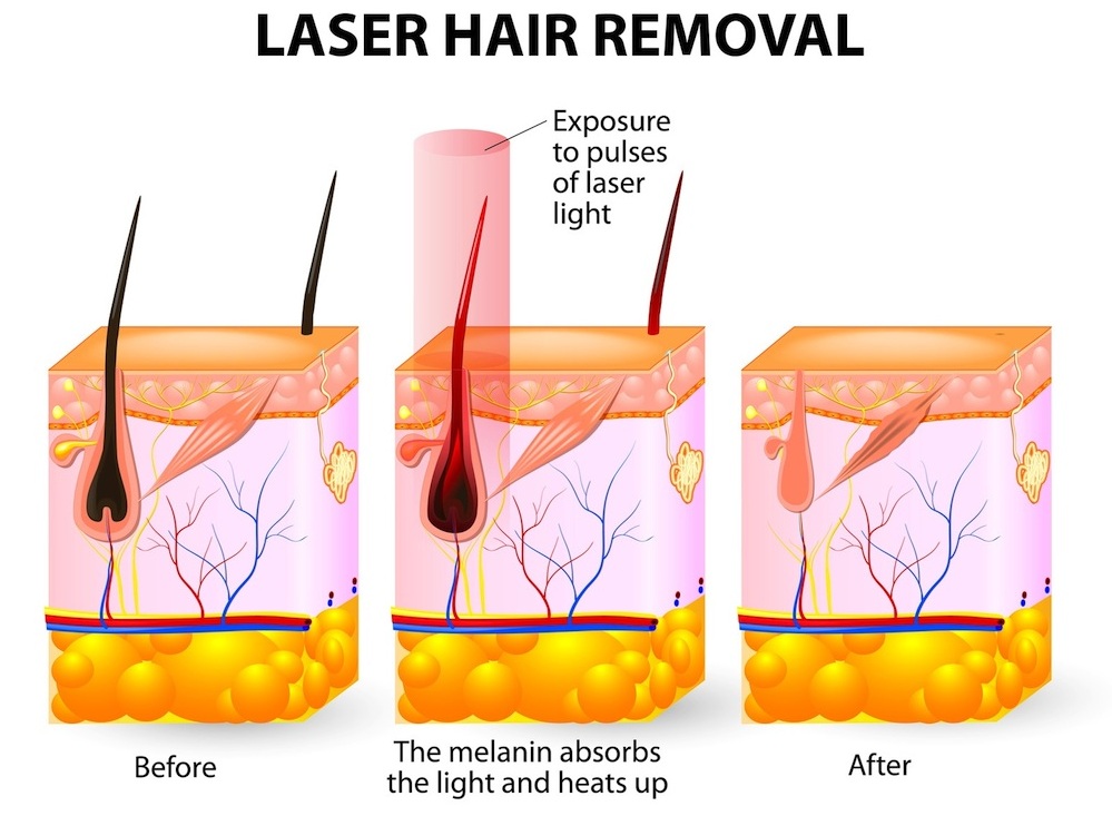L'épilation laser est une procédure esthétique populaire qui, lorsqu'elle est réalisée correctement, peut offrir des résultats durables avec des effets secondaires minimes.