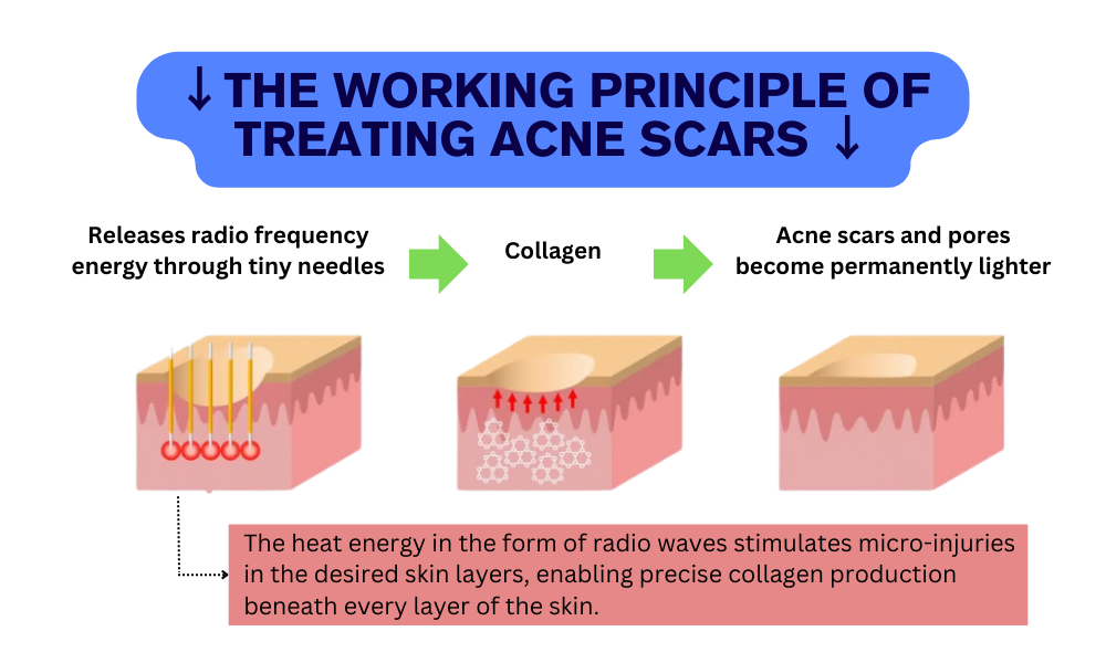 Micro-Needle Rf Acne Scar Treatment, A New Alternative For Collagen Production (3)1j0