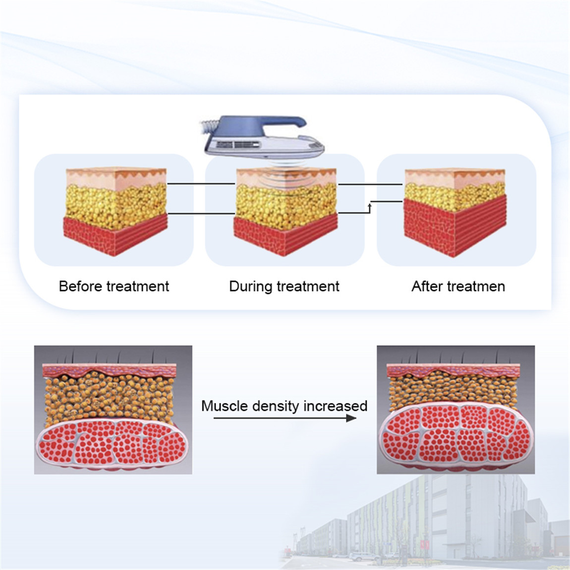 EMS Body Contouring Principles01i91