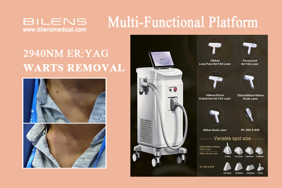 2940nm Erbium:YAG (Er:YAG) laser effectively removes persistent or recalcitrant warts by vaporizing infected tissue layer-by-layer