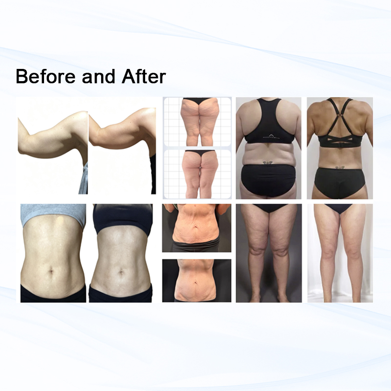 Microwaves Body Contouring Systems