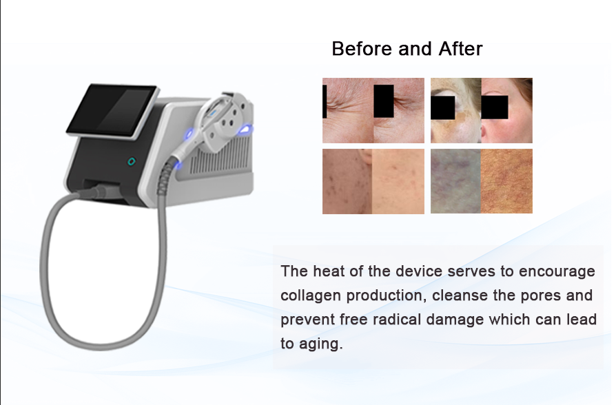 What is IPL Skin Rejuvenation?