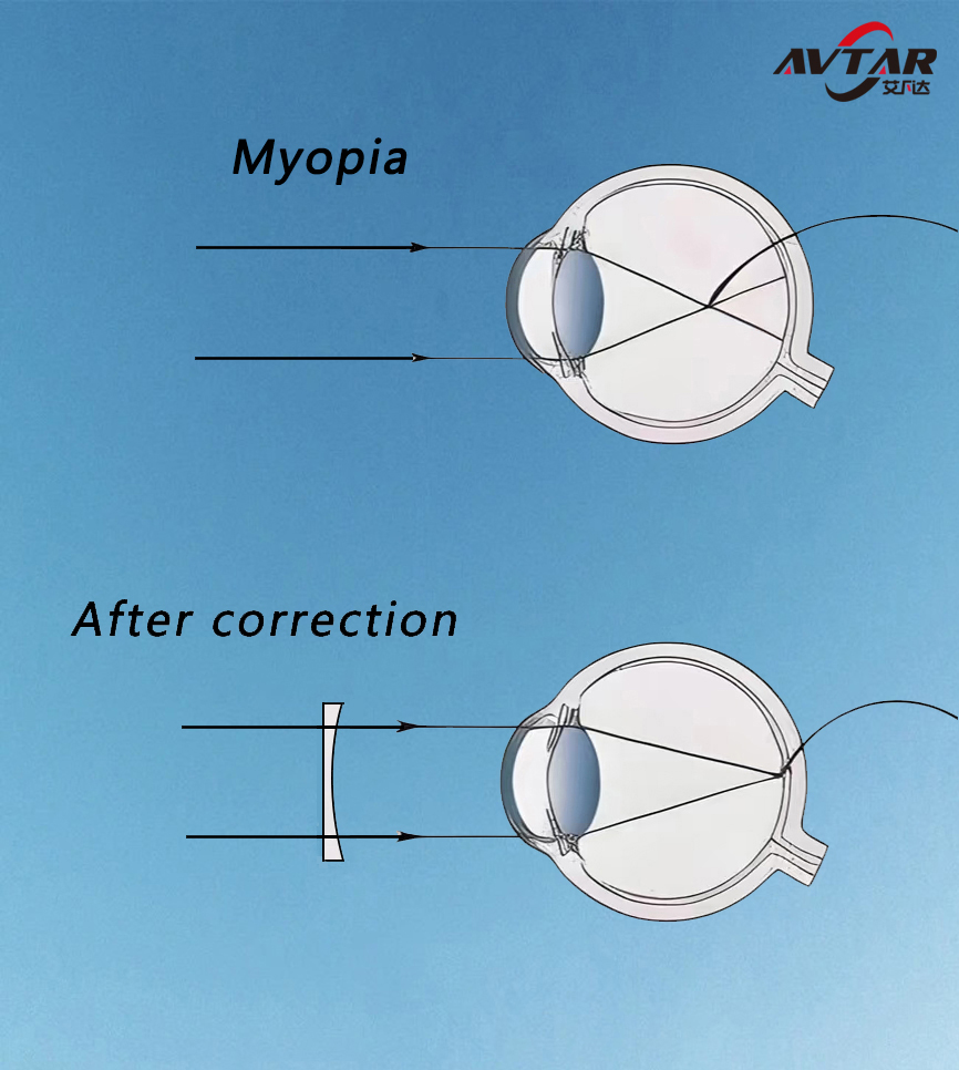 Myopia&Hyperopia&Astigmatism