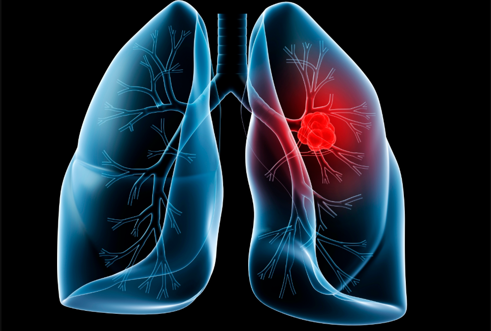 Lung cancer rates surge among non-smokers — could any one of us be the next victim?