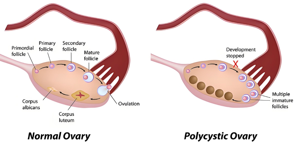 Polycystic Ovary.jpg