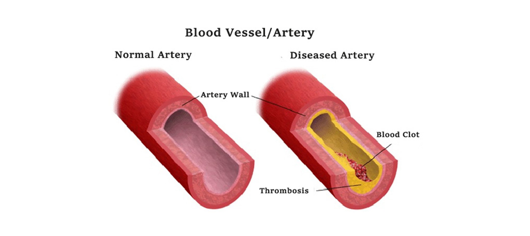 Quercetin can lower blood pressure