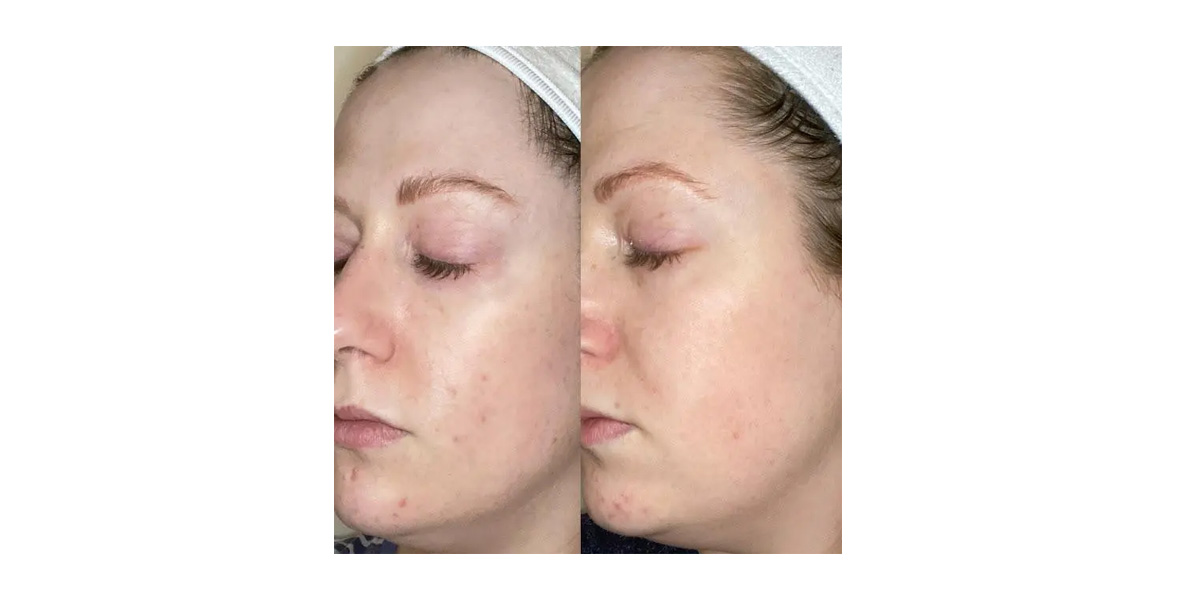 ursolic acid helps repair skin damage