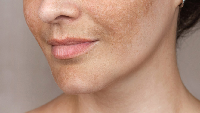 Diglucosyl gallic acid can reduce the occurrence of pigmentation and improve uneven skin tone by inhibiting the activity of tyrosinase and suppressing the production of melanin.jpg