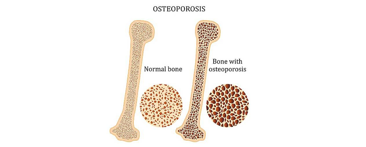 Genistein has been studied for its ability to promote bone density and reduce the risk of osteoporosis