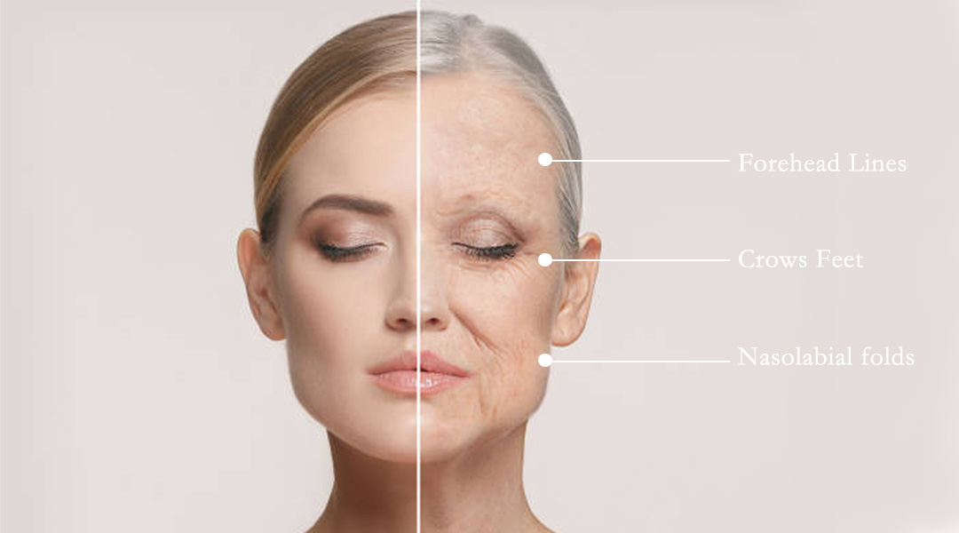 Illustration of wrinkles