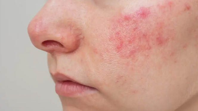 Shikimic acid has strong anti-inflammatory effects and can alleviate skin inflammation.jpg