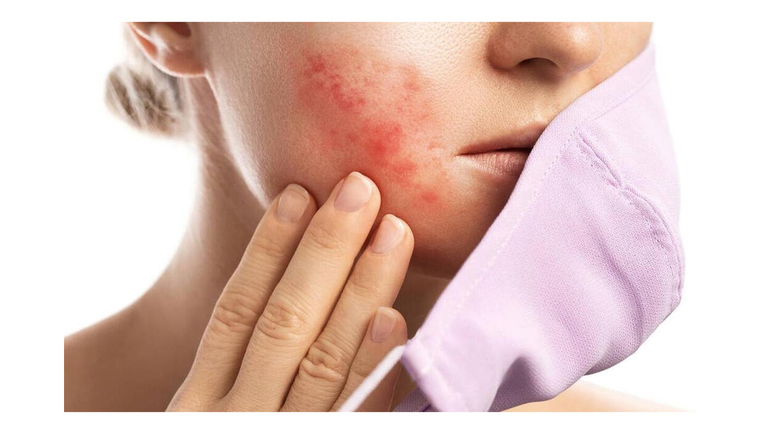 Tribulus terrestris can treat allergies