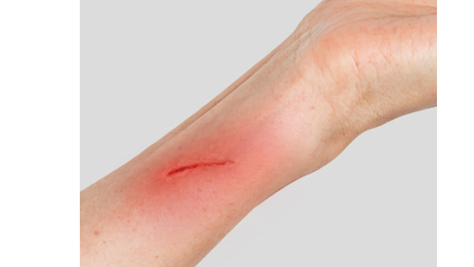podophyllotoxin Wound aggravation due to overuse