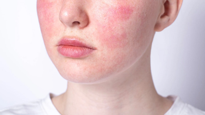redness