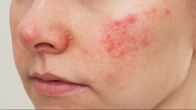 While caffeic acid has many benefits for the skin, some people with easily sensitive skin may experience skin irritation when using caffeic acid skin care products.jpg
