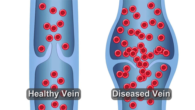 aescin mprove the elasticity and tone of veins