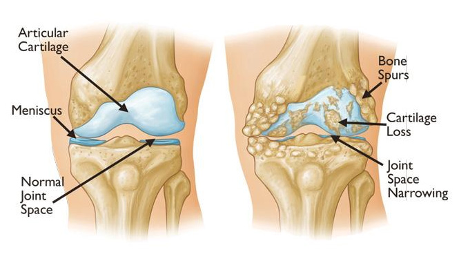 arthritis