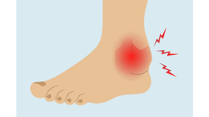 iRelieve edema