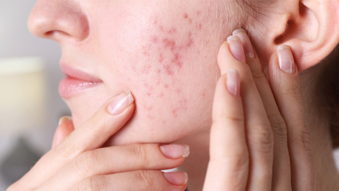 Antibacterial acne treatment