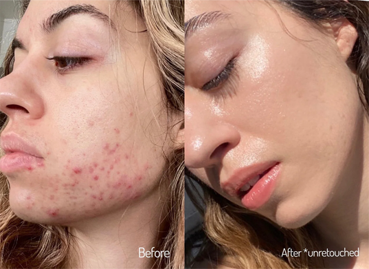 Bakuchiol for acne
