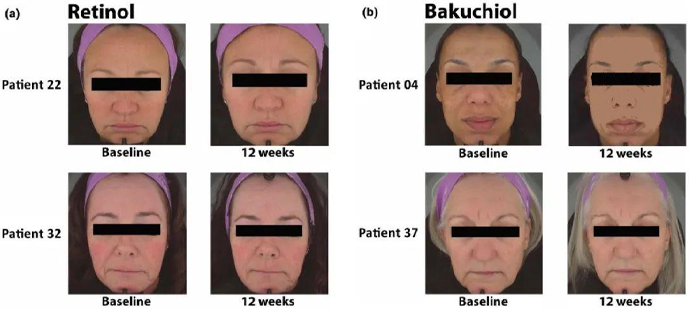 Bakuchiol vs Retinol Before and After