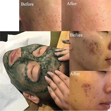 Hydrolyzed Sponge Spicules In Skincare Hydrolyzed Sponge Spicules In Skincare
