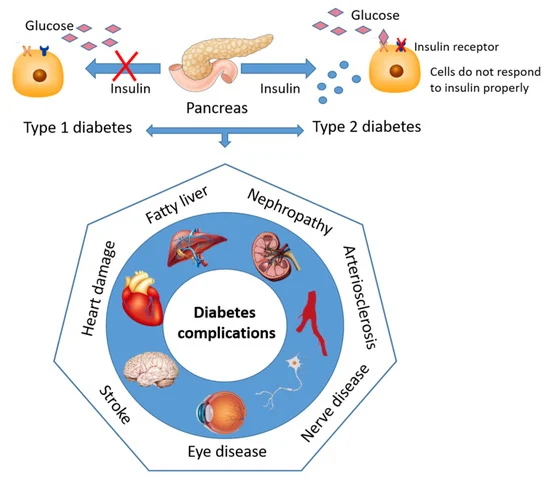 Major microvascular and macrovascular complications associated with diabetes mellitus.