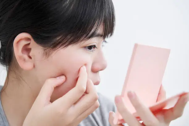Acne Improvement