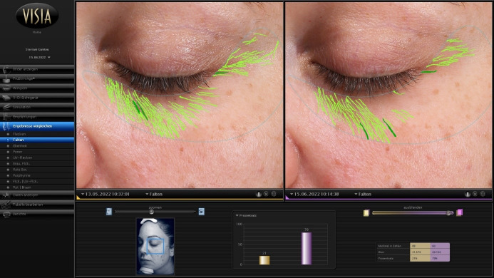 argireline anti wrinkle
