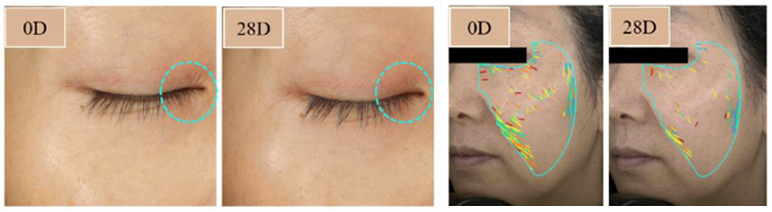 Hydroxypinacolone Retinoate for Anti-aging and wrinkle reduction