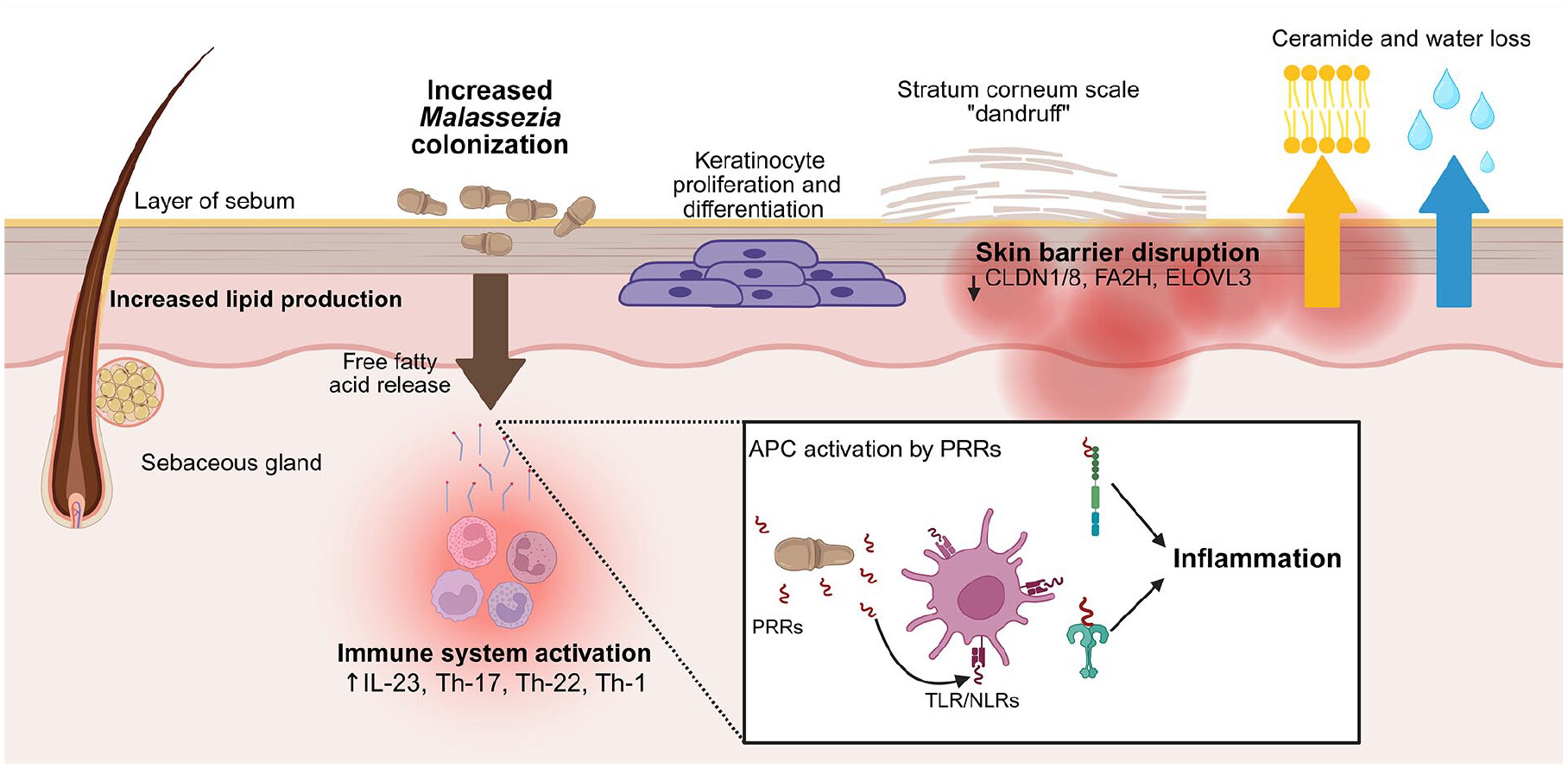 Pathophysiology of seborrheic dermatitis