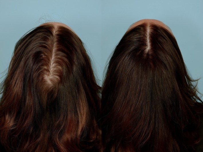 saw palmetto extract hair