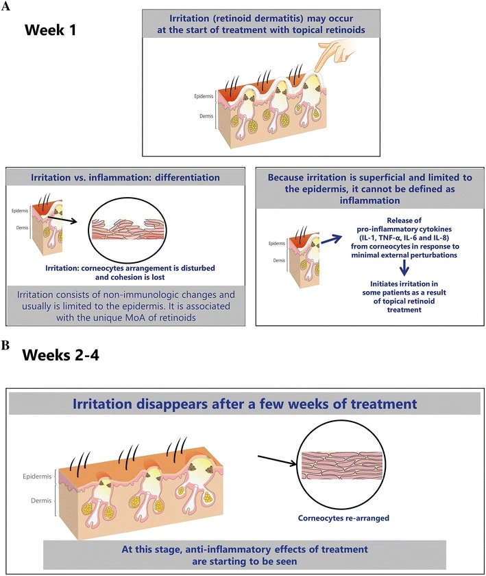 tretinoin for acne