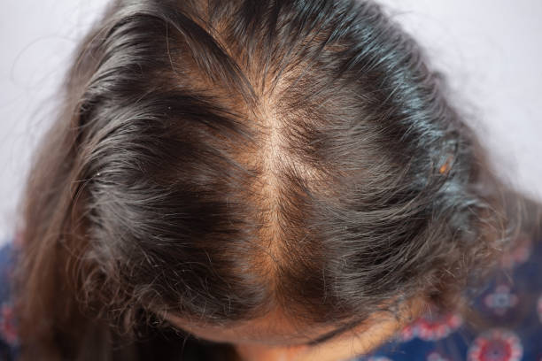 rosemary extract hair growth