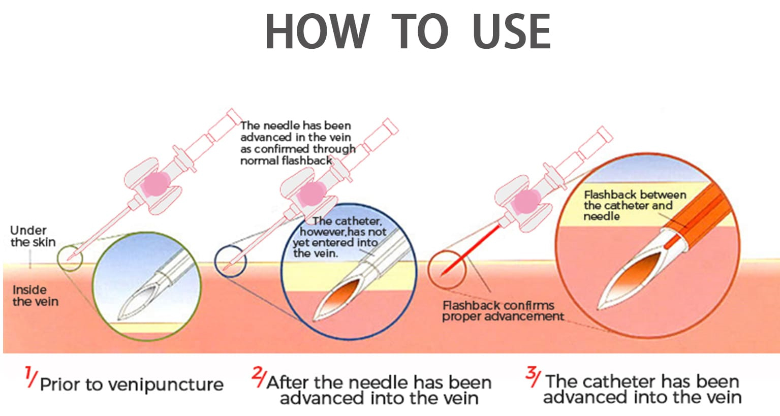 IV catheter 05