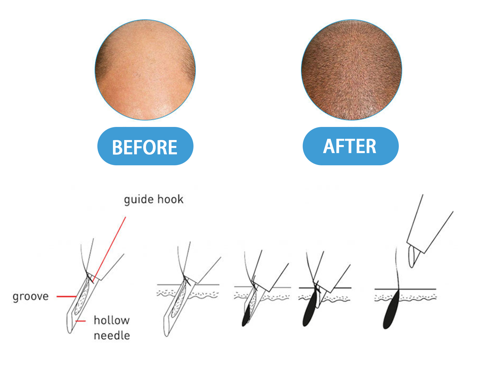 hair-implanter-needle-02