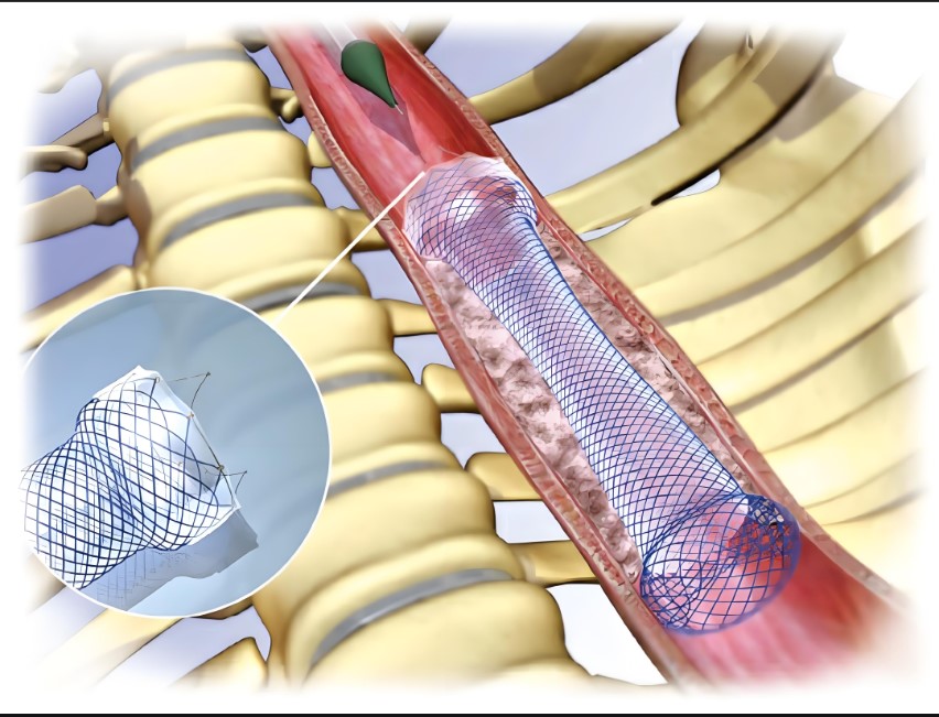 alloy intestinal stent-1.jpg