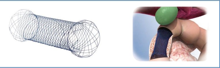 Metal drainage stent.jpg
