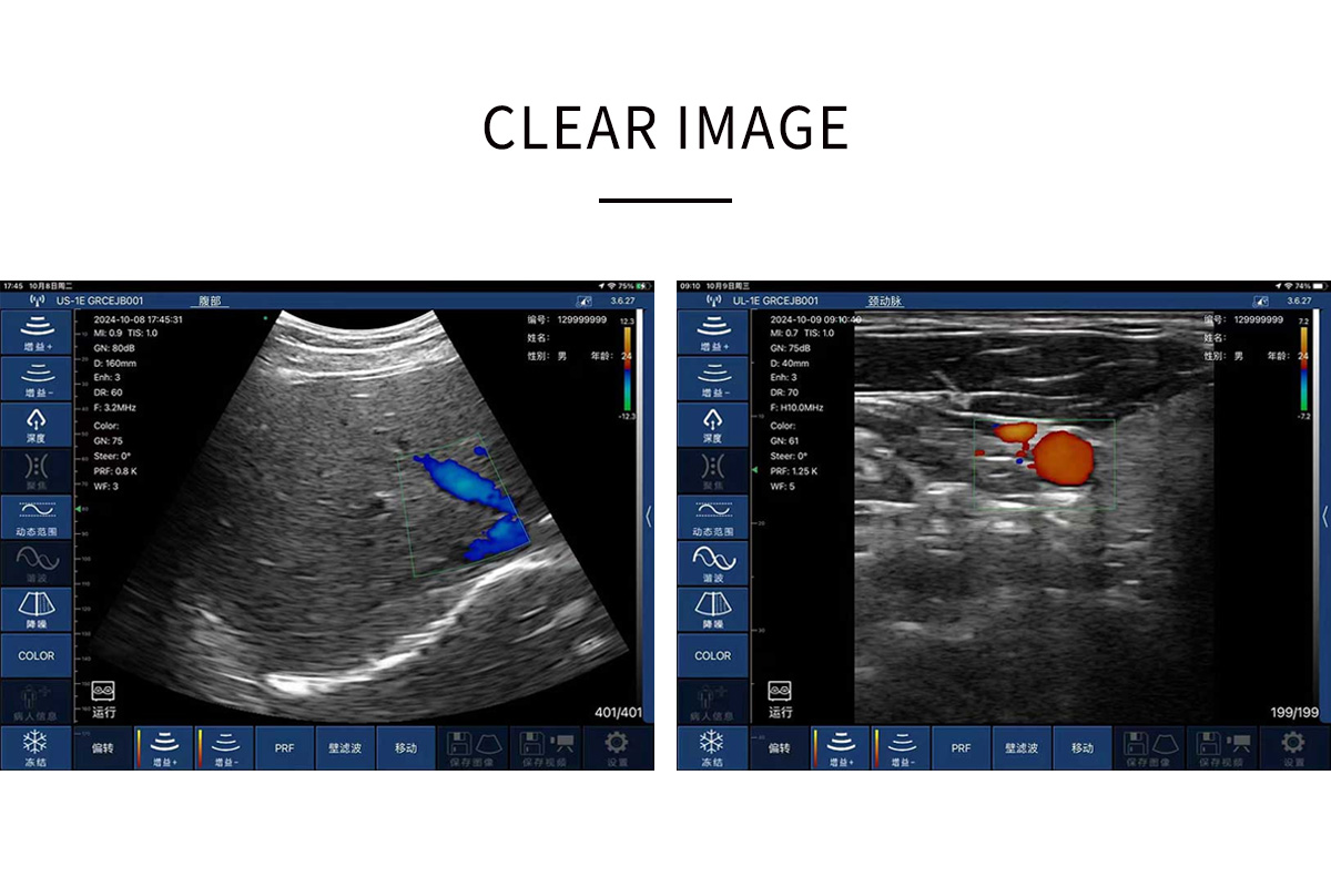 CW-3CL palm doppler ultrasound-detail 3