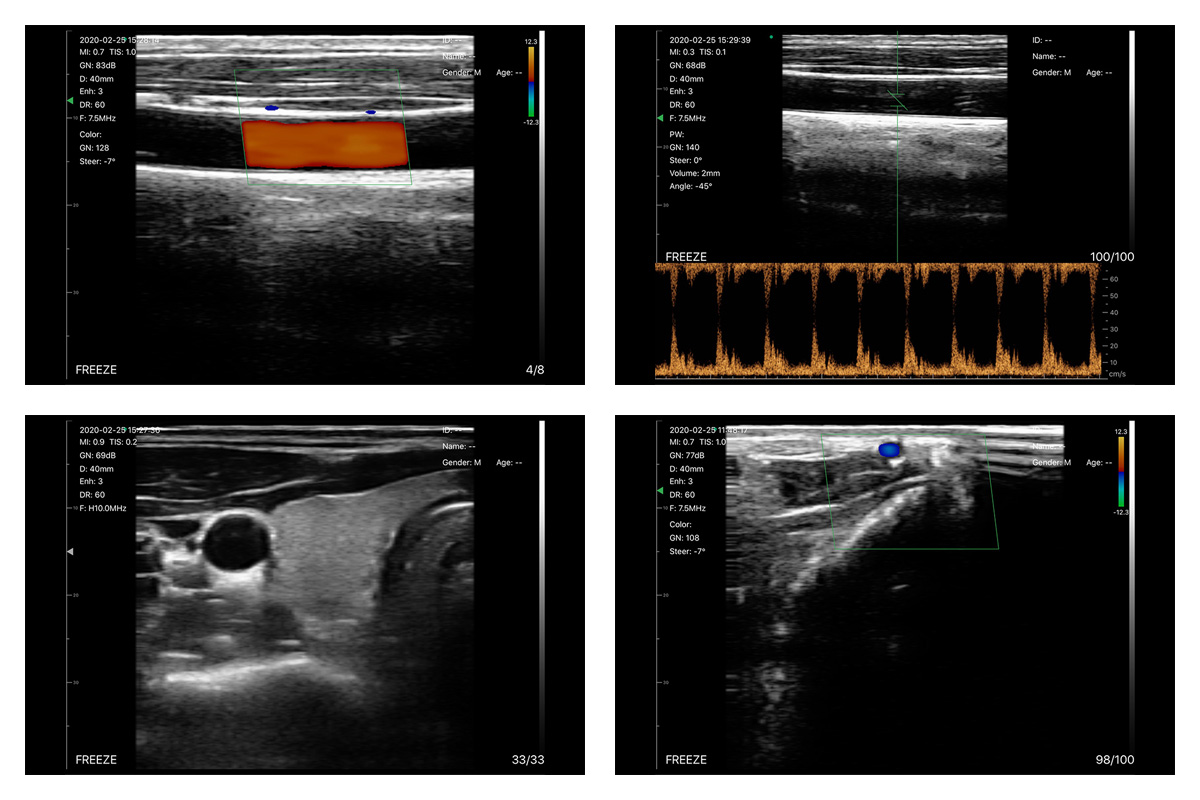 CW-5L linear palm doppler ultrasound-detail 4