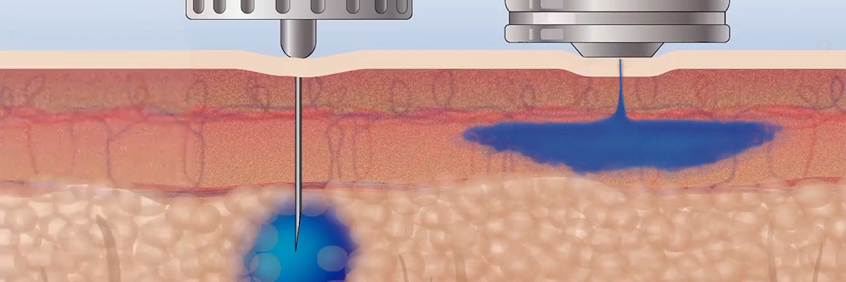 the advantages of Veterinary Needle-Free Injector-1.jpg