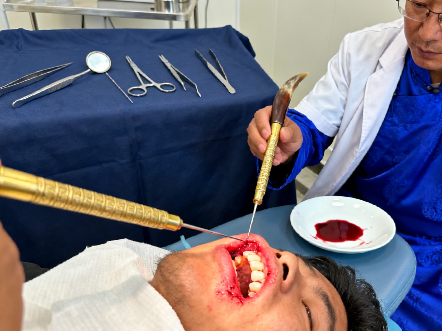 الطب التبتي التقليدي - الفصد