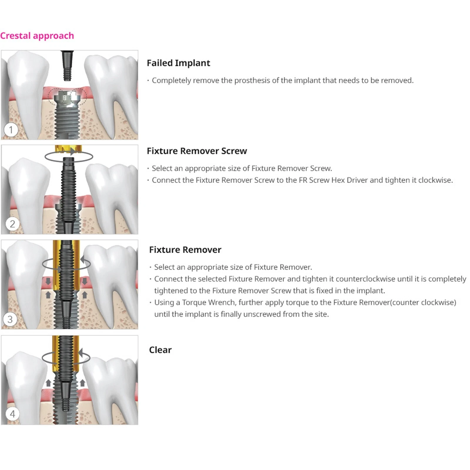 Kit d'extraction d'implants dentaires (16).png