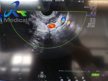 GE IC9-RS Endocavity Ultrasound Transducer Probe Ultrasound Machine